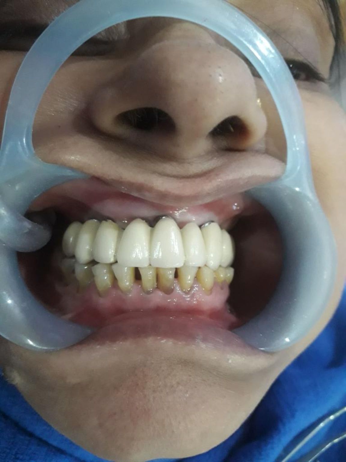Implant image