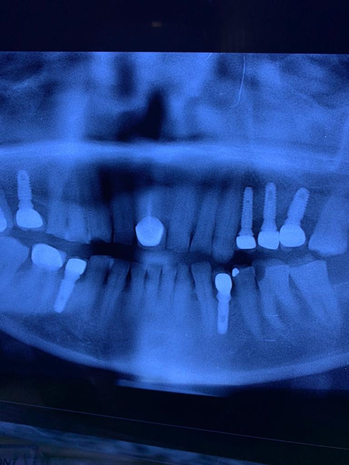 Implant image