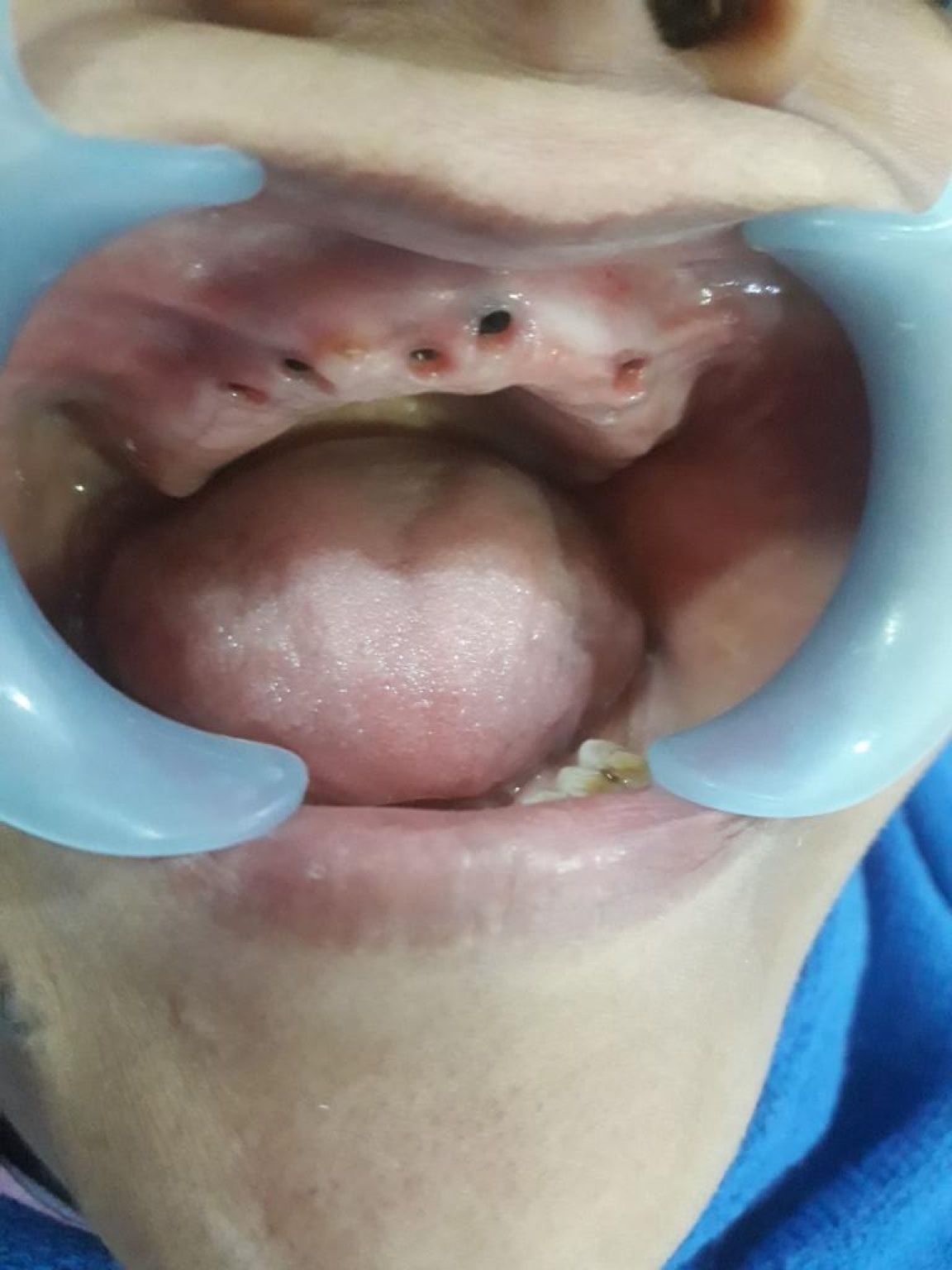 Implant image