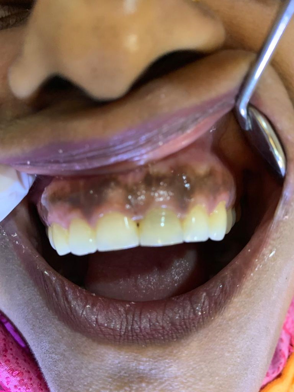 teeth whitening