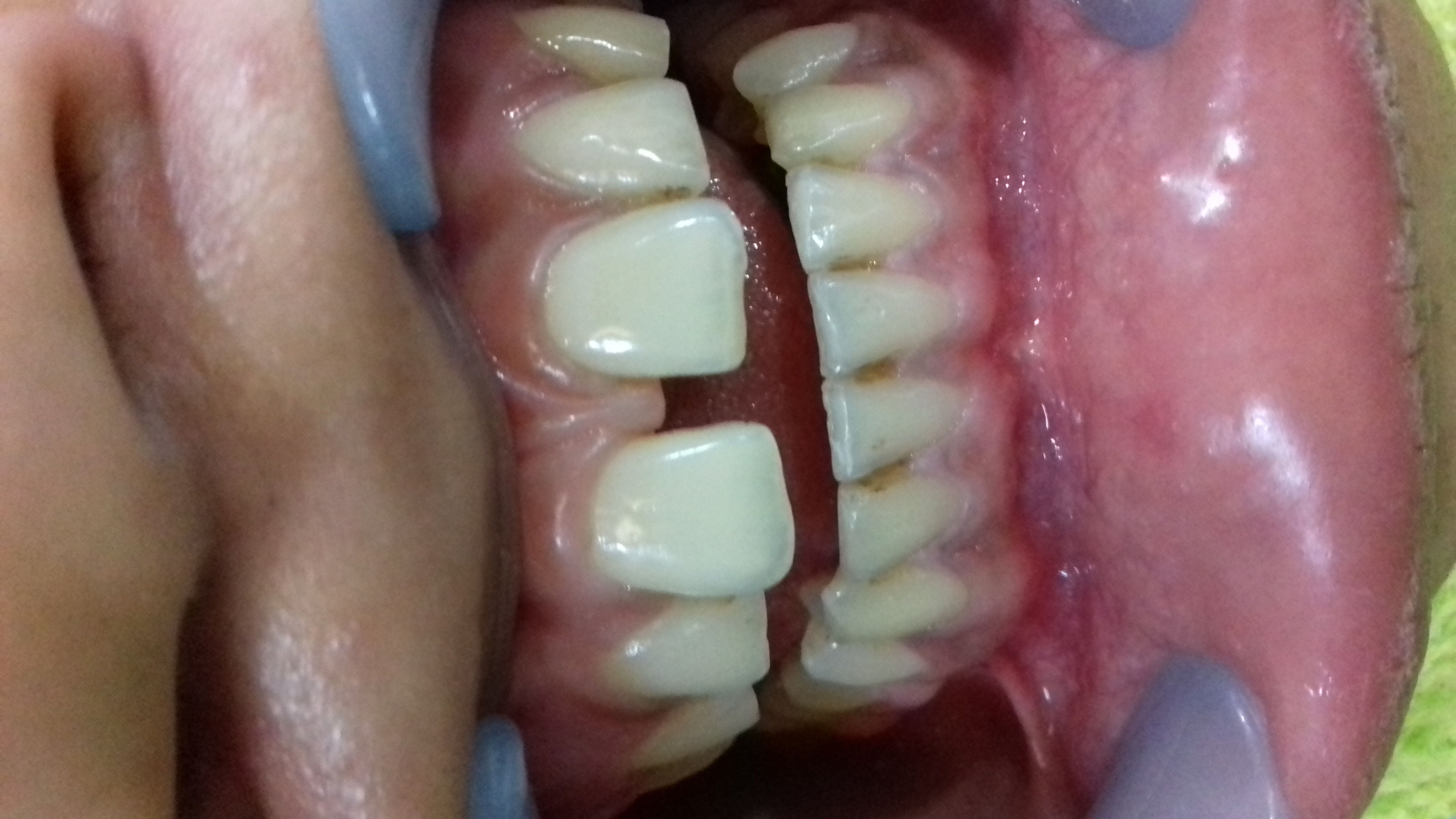 Dental Fillings