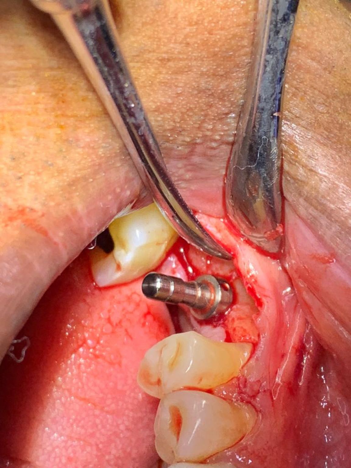 Implant image