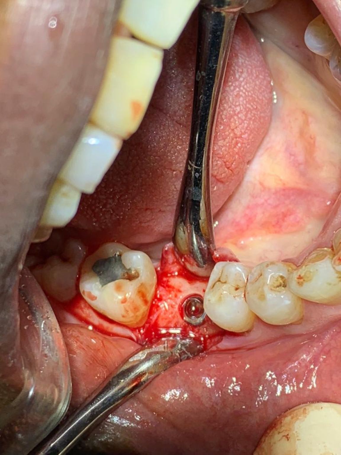 Implant image