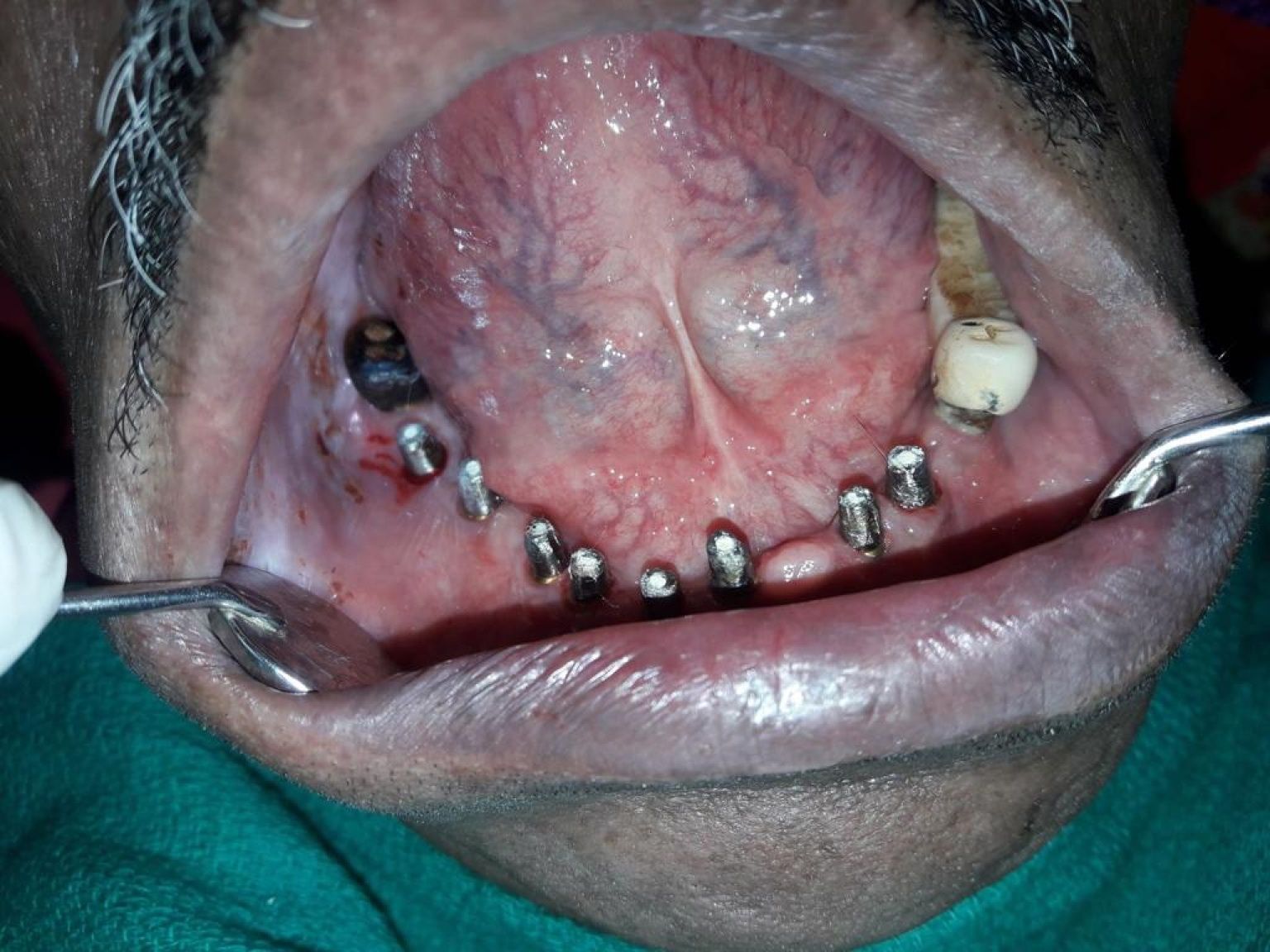 Implant image