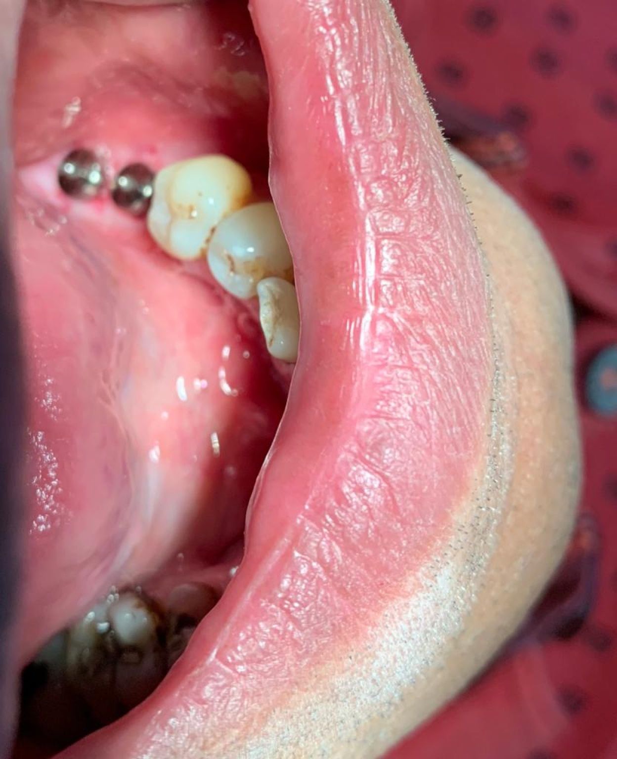 Implant image