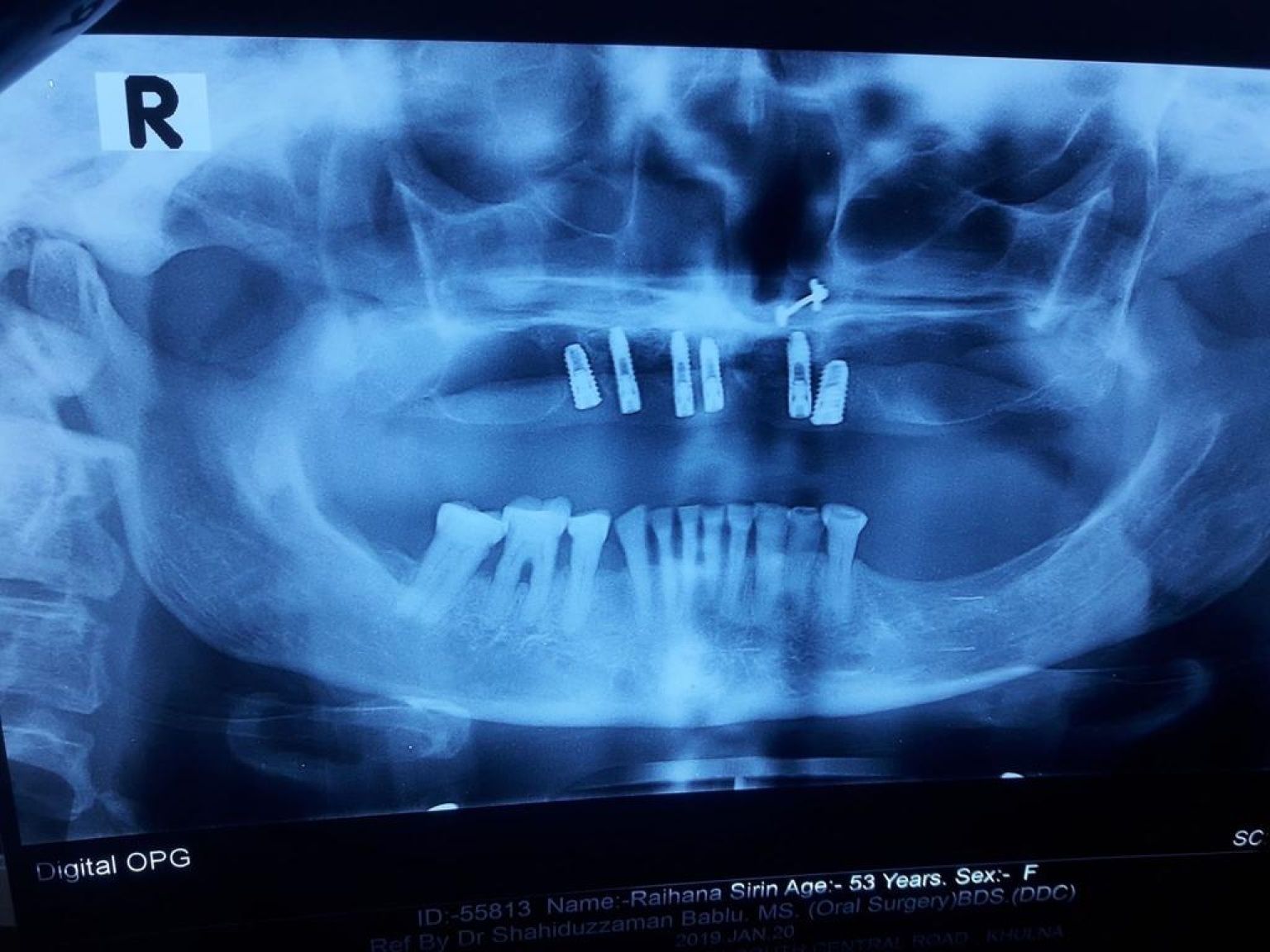 Implant image