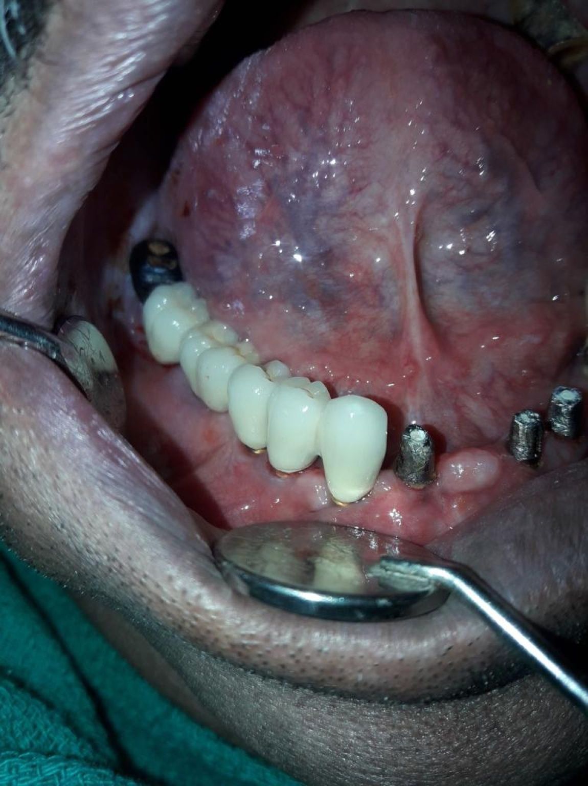 Implant image