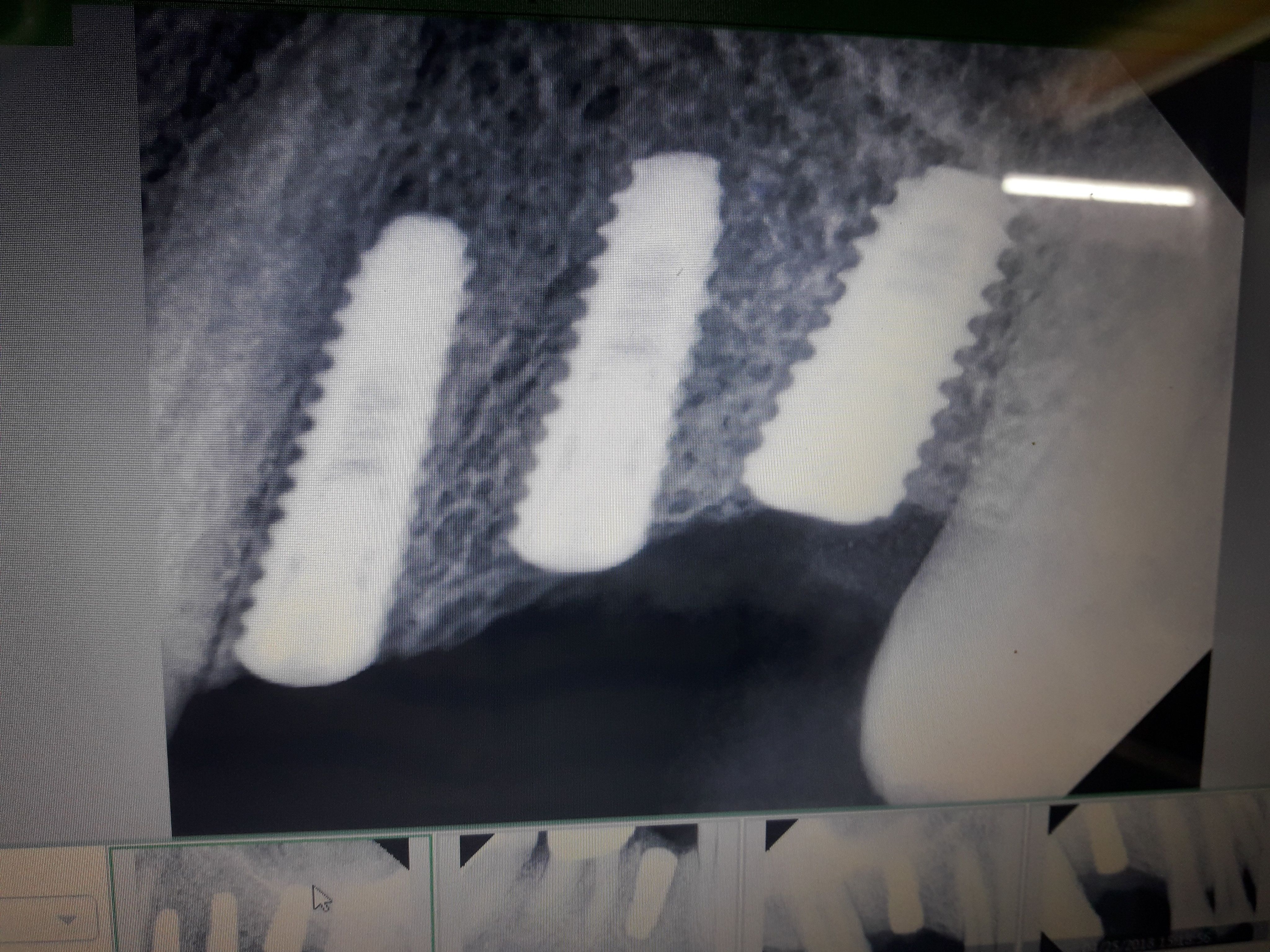 Implant image