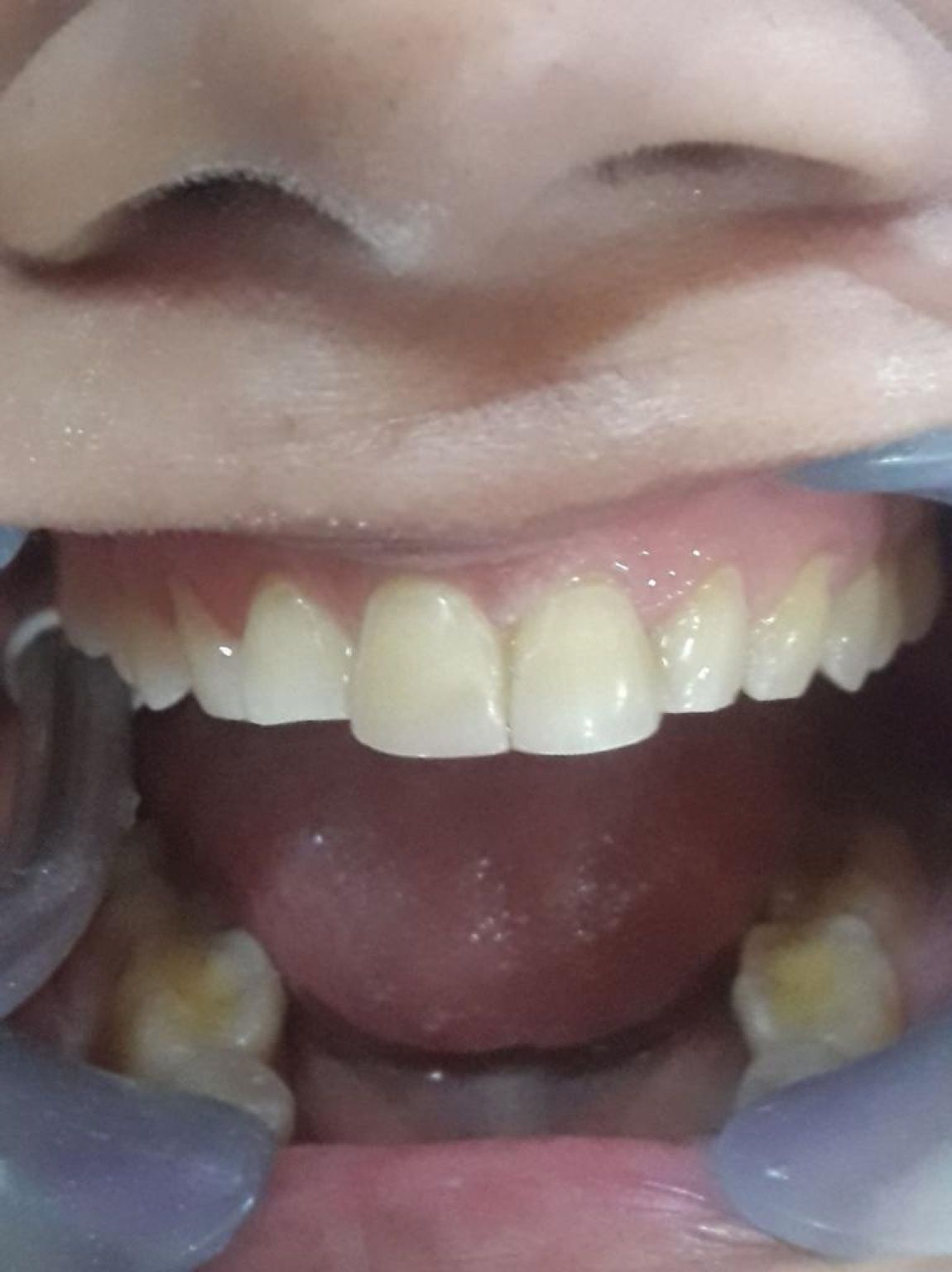 Dental Fillings