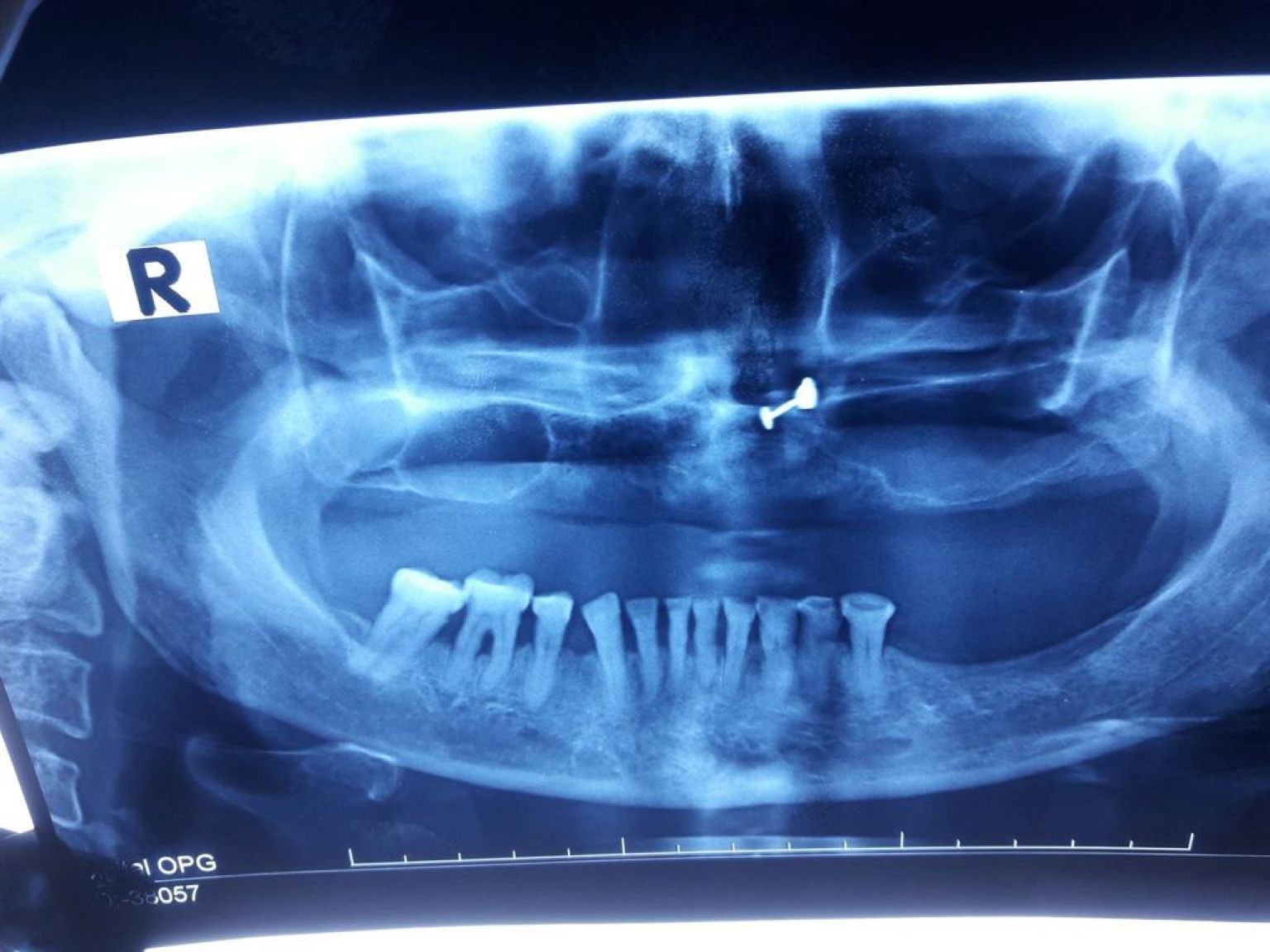 Implant image