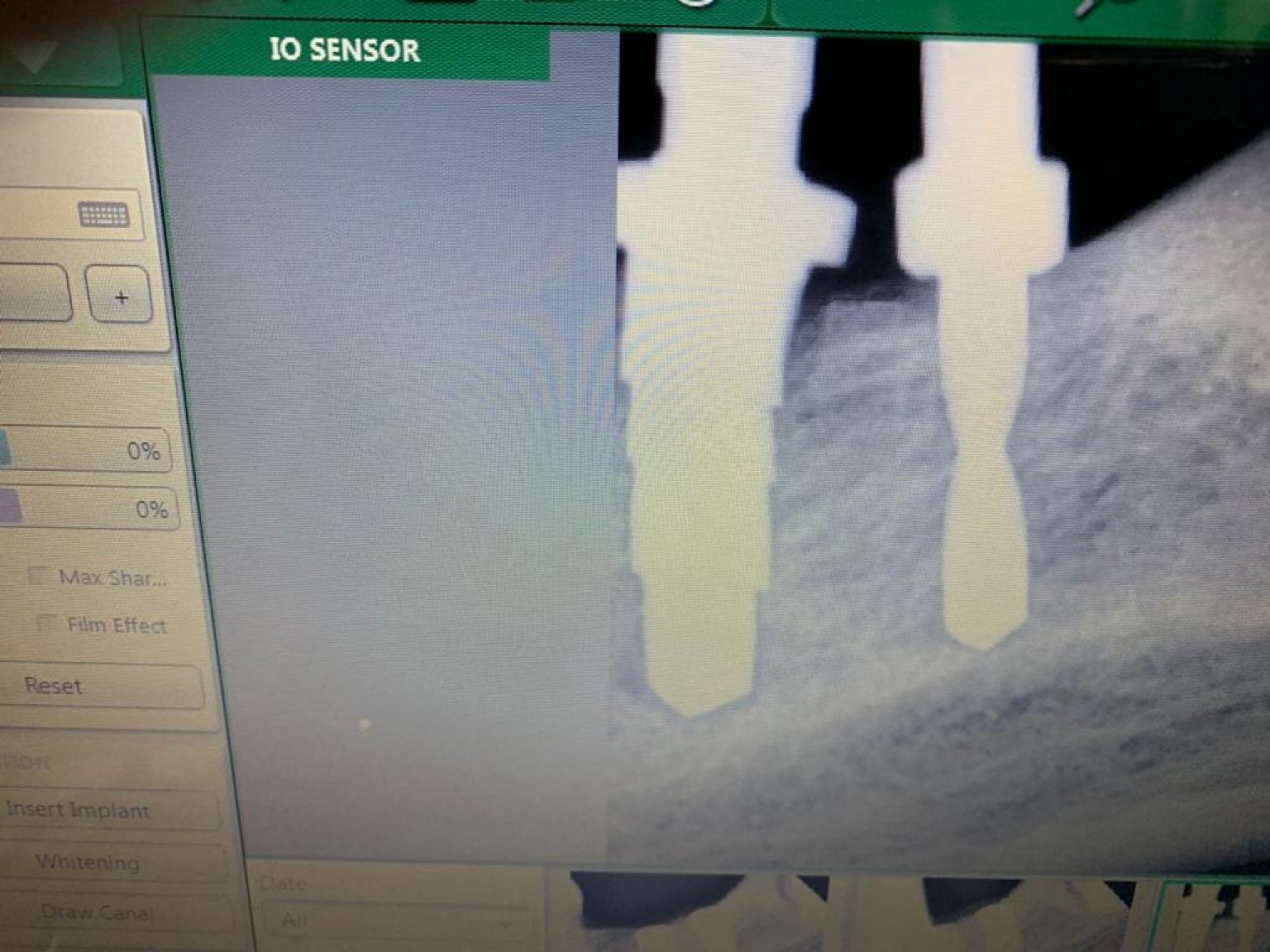 Implant image