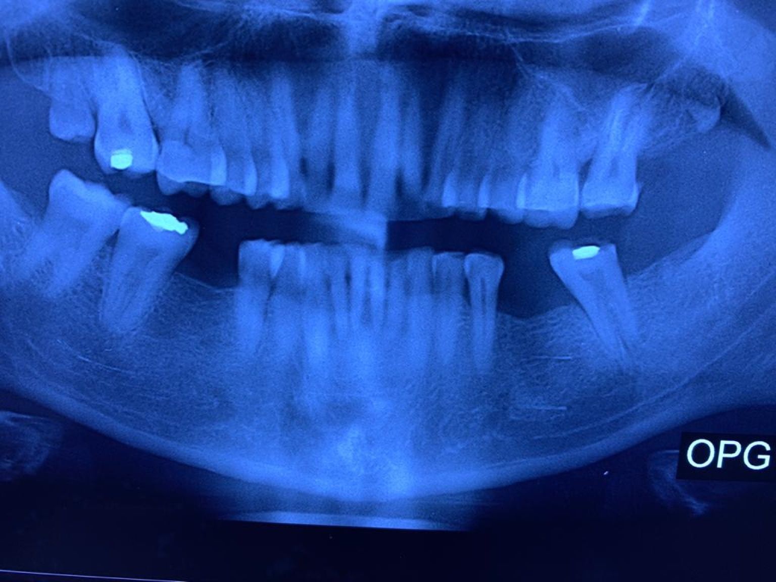 Implant image