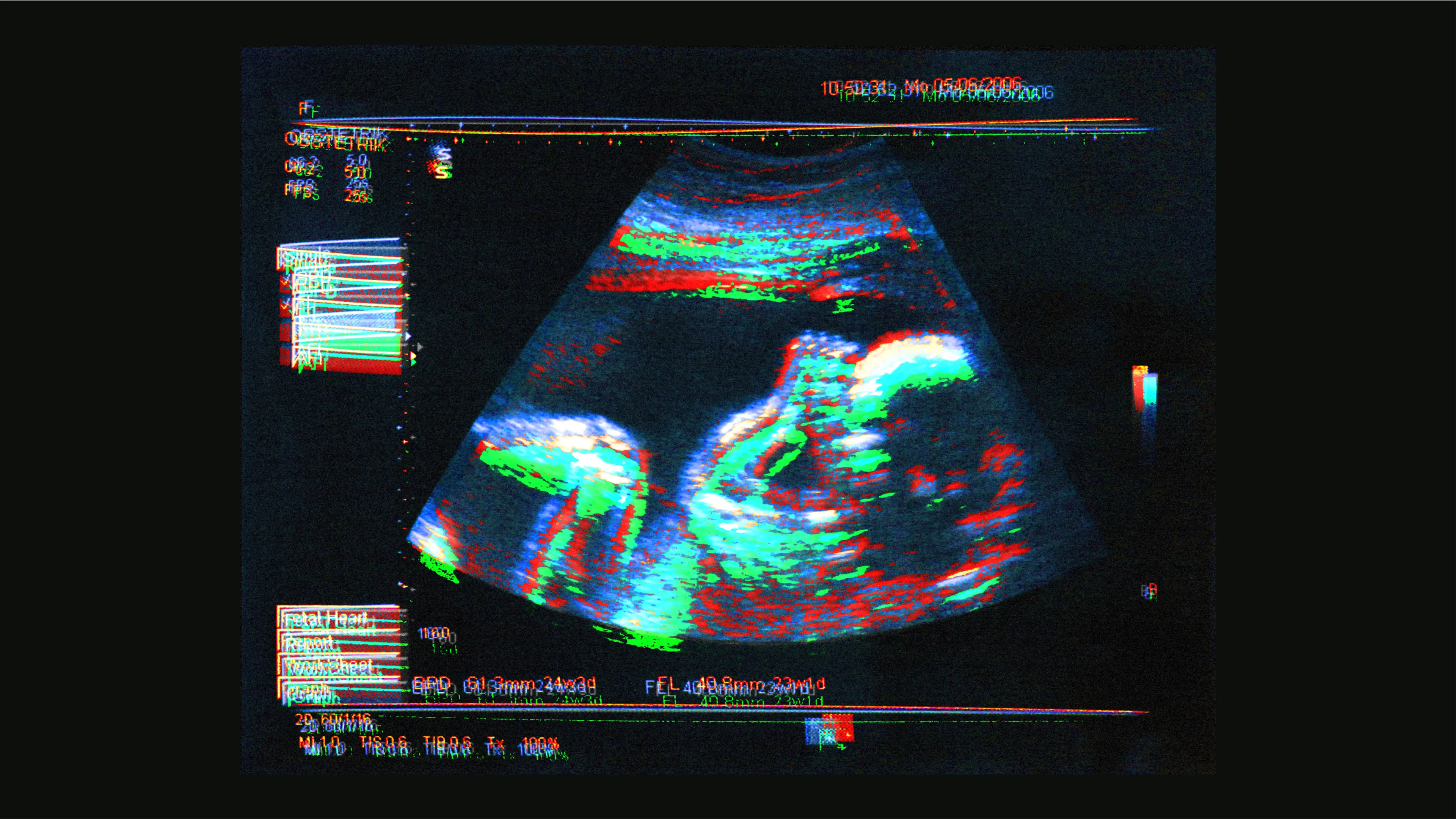 ultrasound