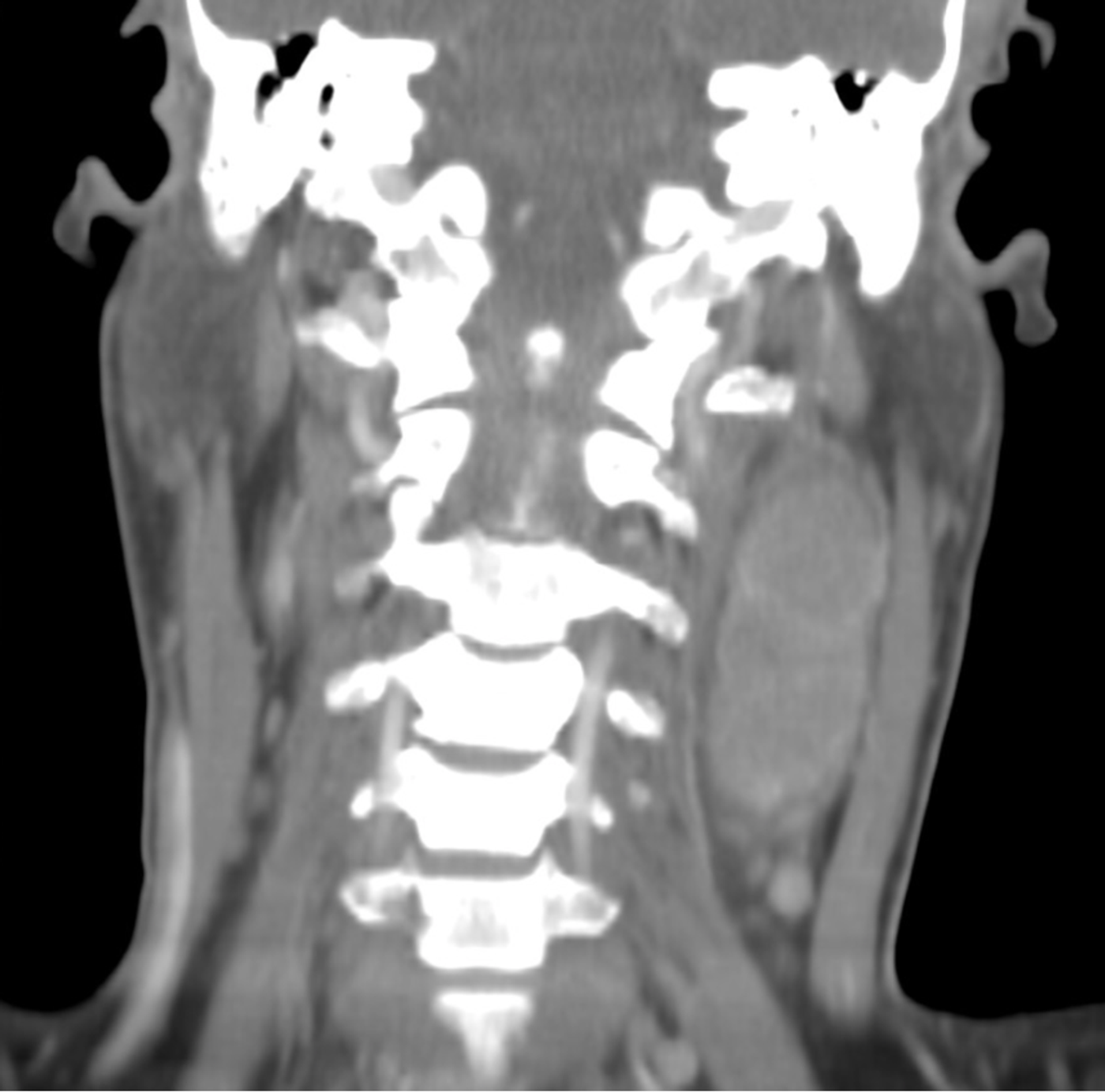 Left sided neck mass