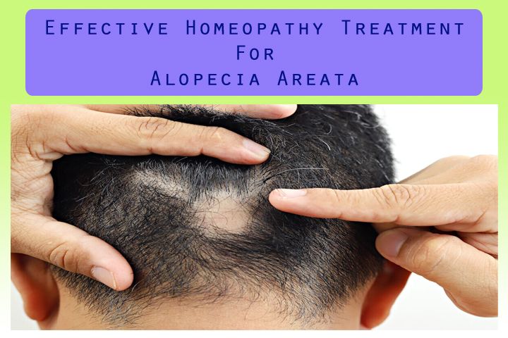 Effective Homeopathy Treatment for Alopecia Areata