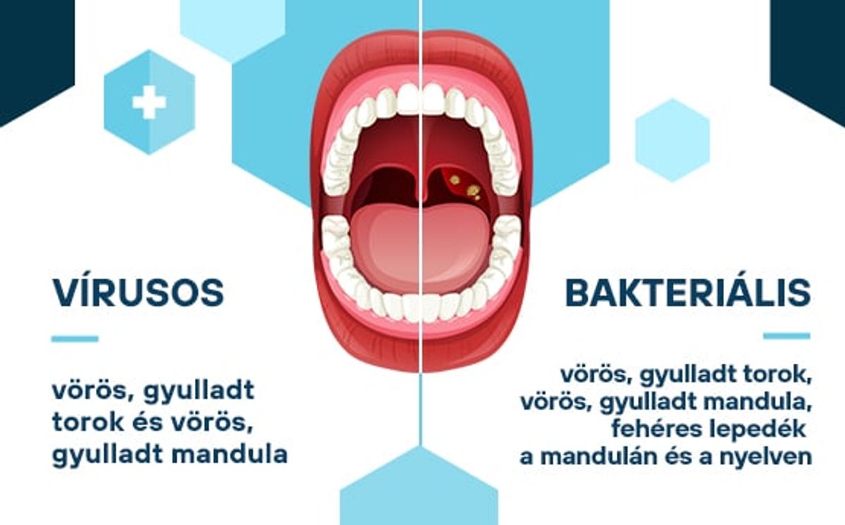 torokgyulladás fajtái