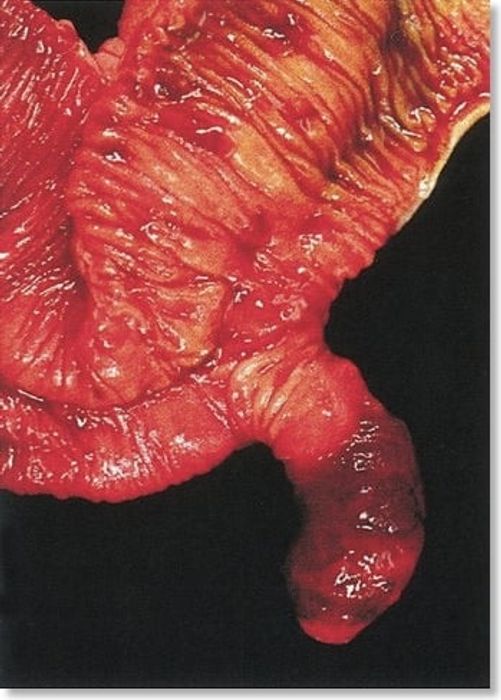 Meckel's Diverticulum — mrcspartbquestions.com