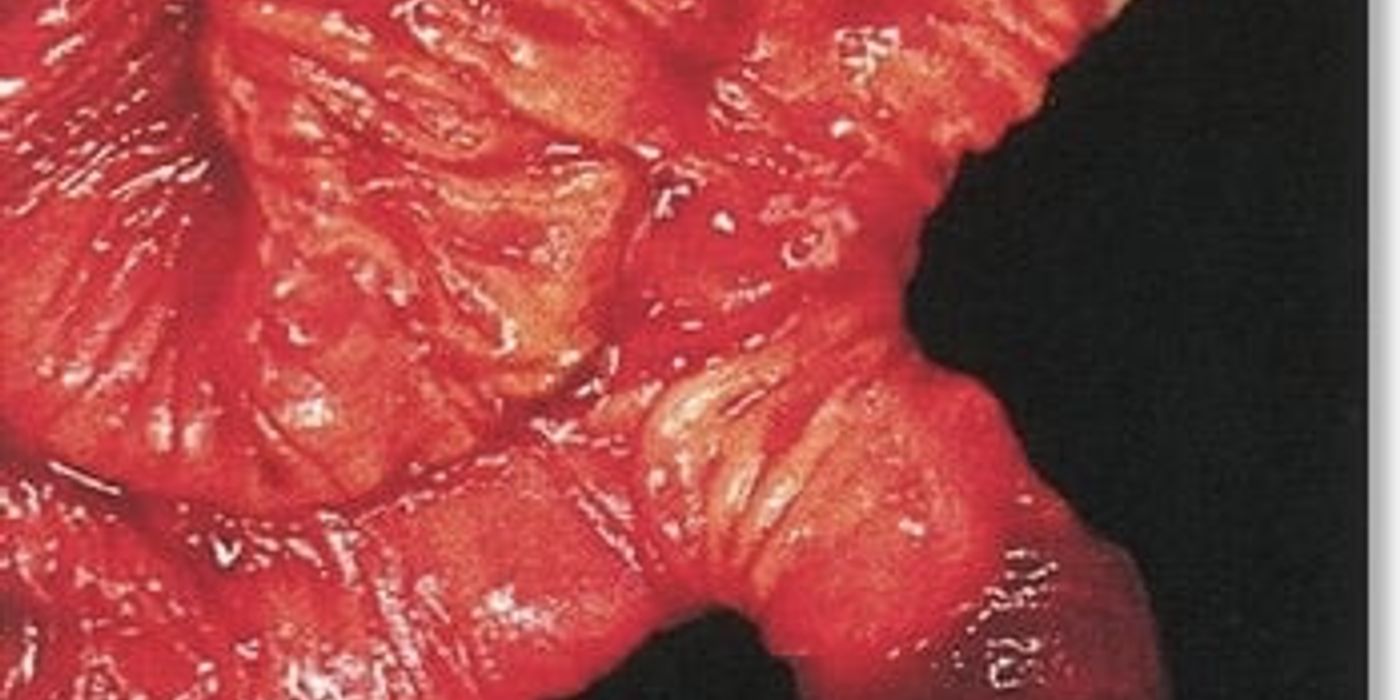 Meckel's Diverticulum — mrcspartbquestions.com