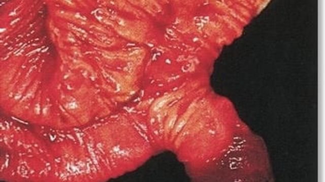 Meckel's Diverticulum — mrcspartbquestions.com