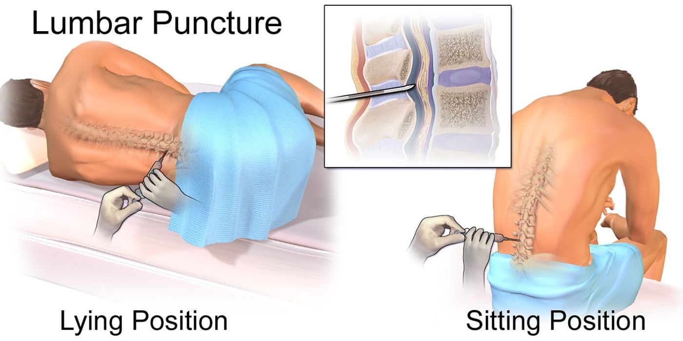 Lumbar Puncture — mrcspartbquestions.com