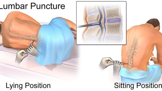 Lumbar Puncture — mrcspartbquestions.com