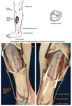 Compartment Syndrome — mrcspartbquestions.com