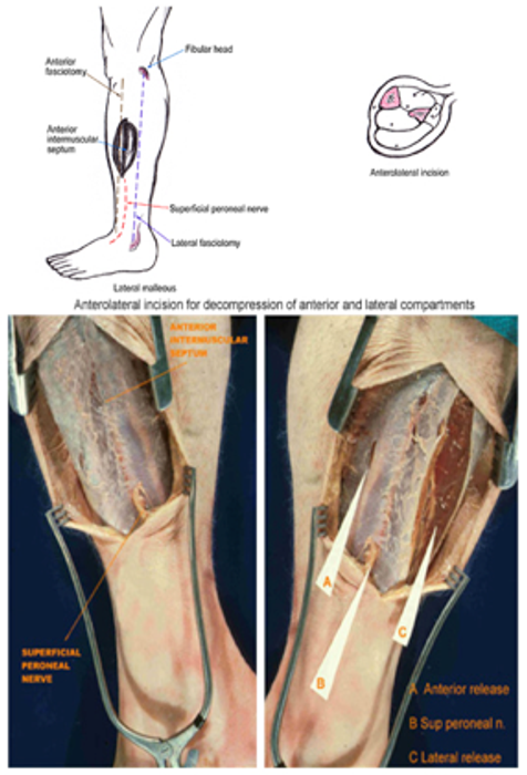 Compartment Syndrome — mrcspartbquestions.com