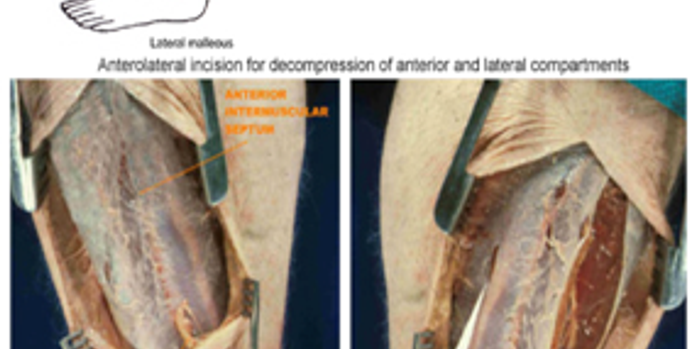 Compartment Syndrome — mrcspartbquestions.com