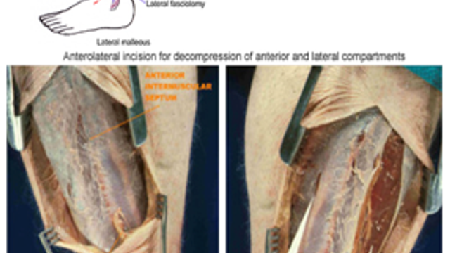 Compartment Syndrome — mrcspartbquestions.com