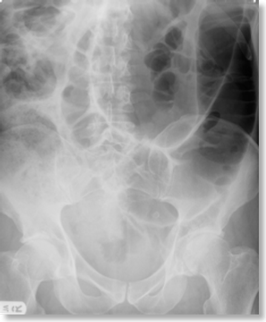 Large Bowel Obstruction — mrcspartbquestions.com