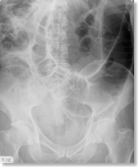Large Bowel Obstruction — mrcspartbquestions.com
