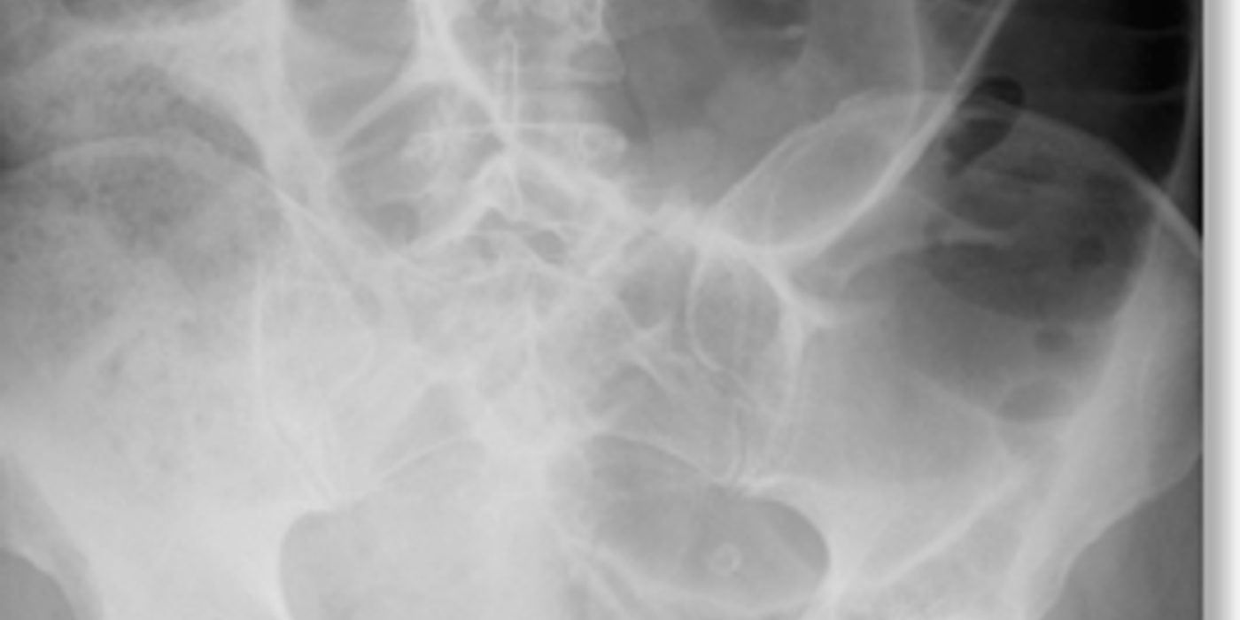 Large Bowel Obstruction — mrcspartbquestions.com