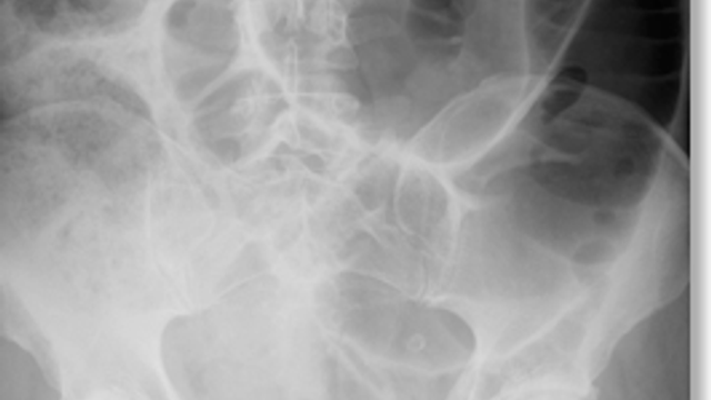 Large Bowel Obstruction — mrcspartbquestions.com