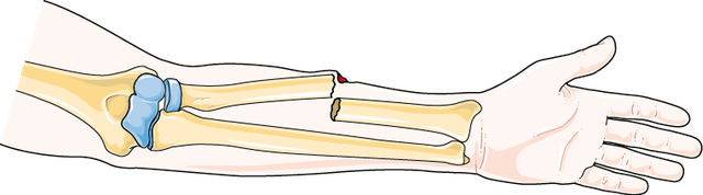 Open Fractures — mrcspartbquestions.com
