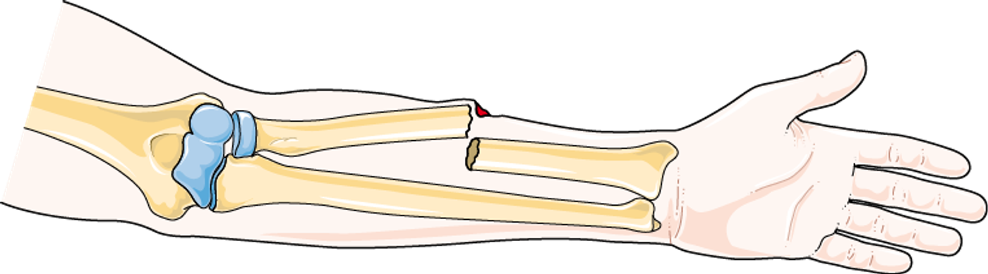Open Fractures — mrcspartbquestions.com