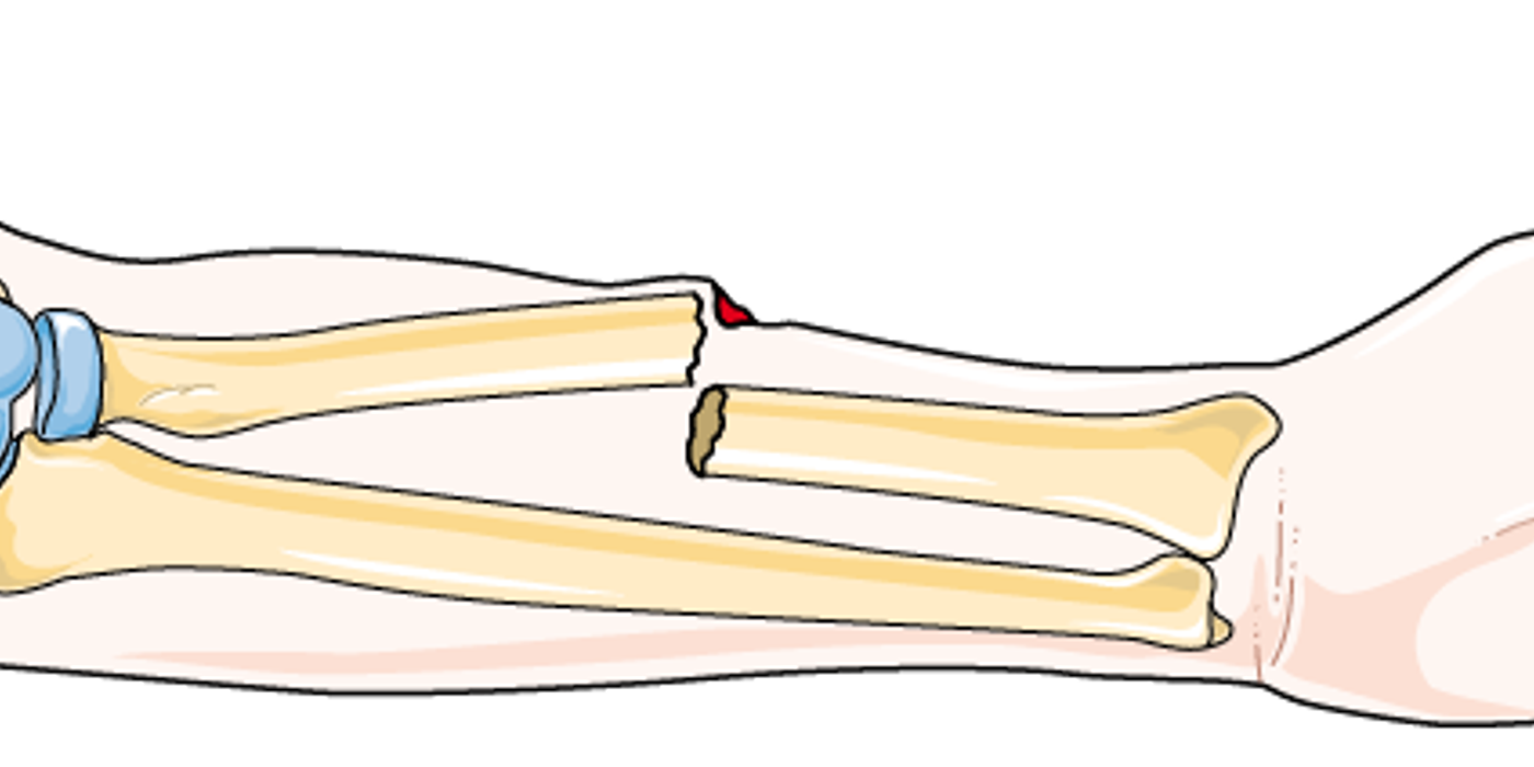 Open Fractures — mrcspartbquestions.com