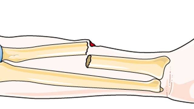 Open Fractures — mrcspartbquestions.com