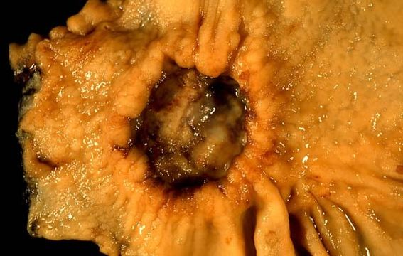 Gastric Carcinoma — mrcspartbquestions.com