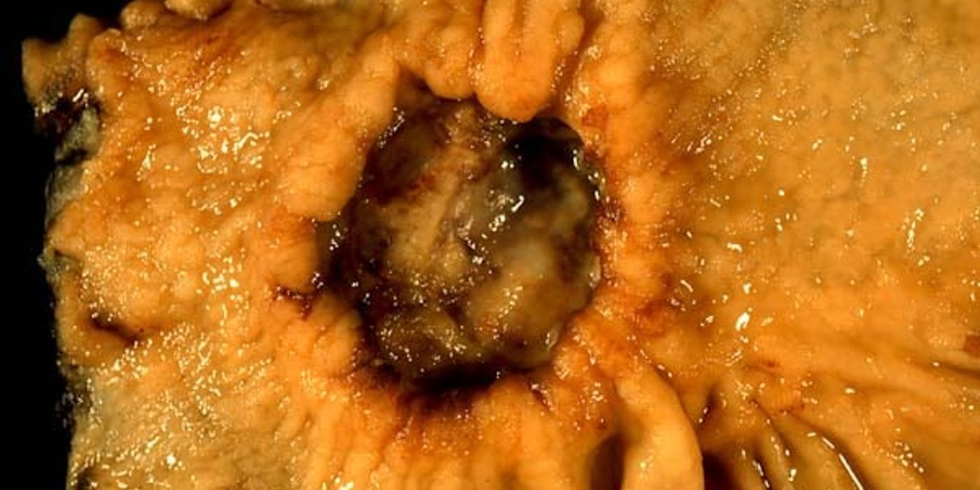 Gastric Carcinoma — mrcspartbquestions.com