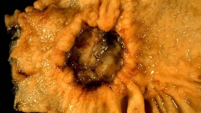 Gastric Carcinoma — mrcspartbquestions.com