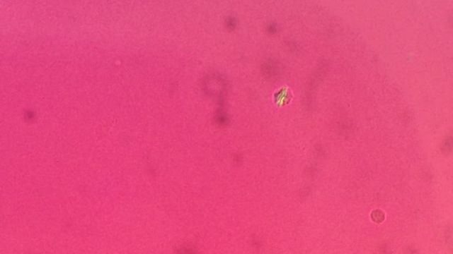 Joint Aspiration — mrcspartbquestions.com
