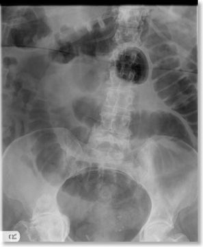 Small Bowel Obstruction — mrcspartbquestions.com
