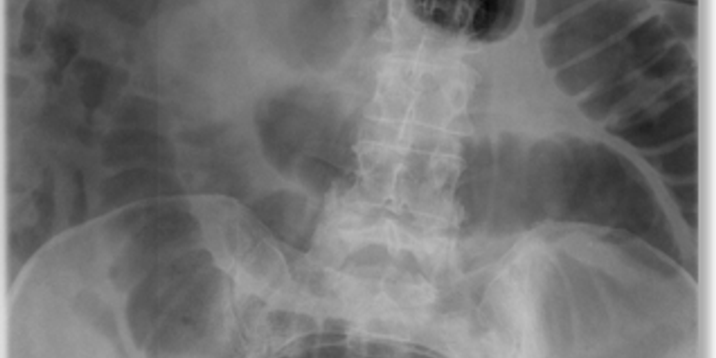 Small Bowel Obstruction — mrcspartbquestions.com