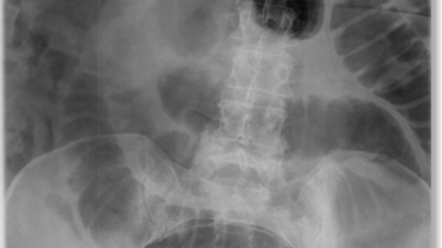 Small Bowel Obstruction — mrcspartbquestions.com
