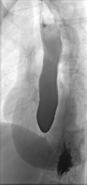 Achalasia — mrcspartbquestions.com