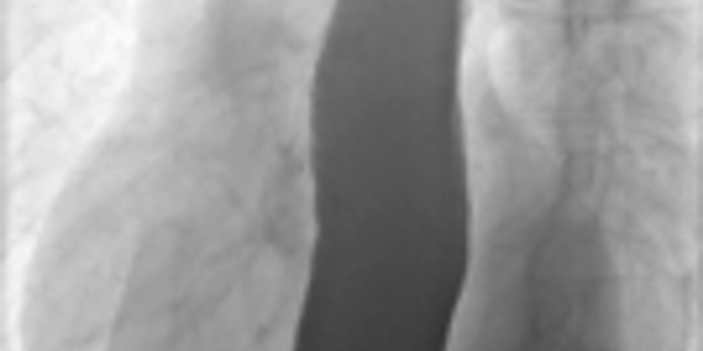 Achalasia — mrcspartbquestions.com