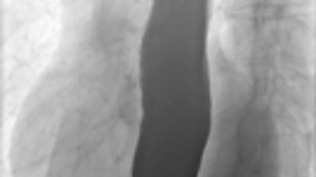 Achalasia — mrcspartbquestions.com