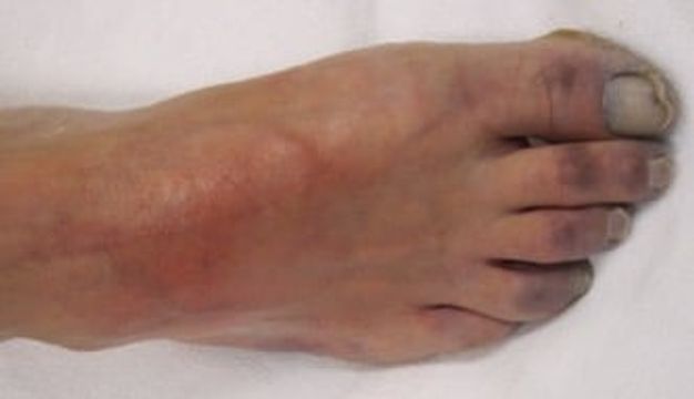 Acute Limb Ischaemia — mrcspartbquestions.com