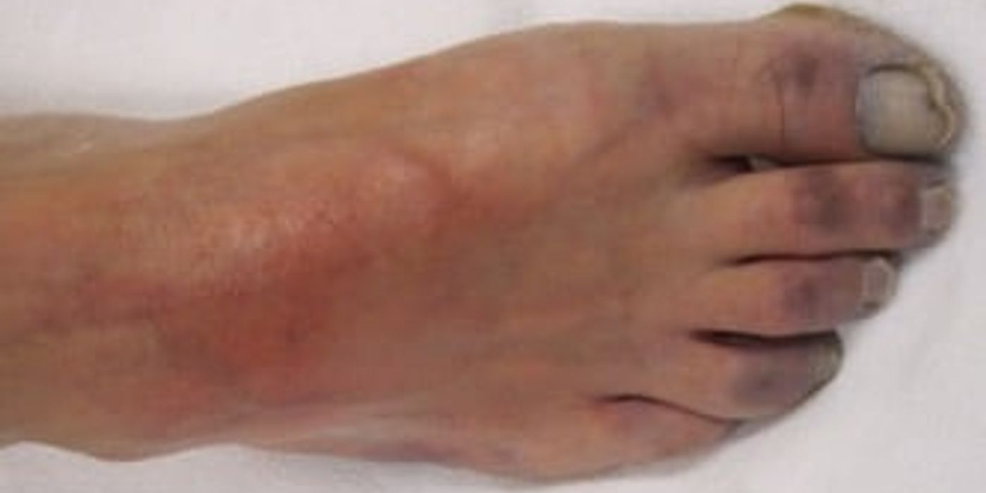 Acute Limb Ischaemia — mrcspartbquestions.com