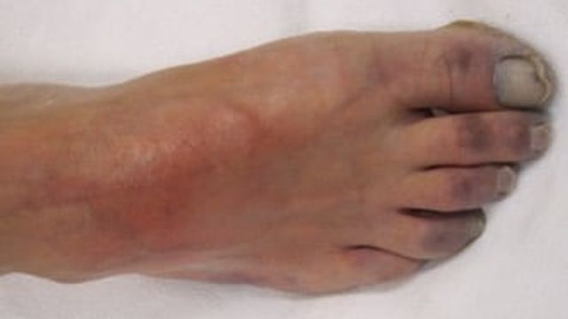 Acute Limb Ischaemia — mrcspartbquestions.com